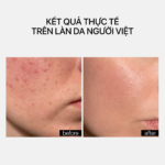 ADULT ACNE TREATMENT - Ảnh 6