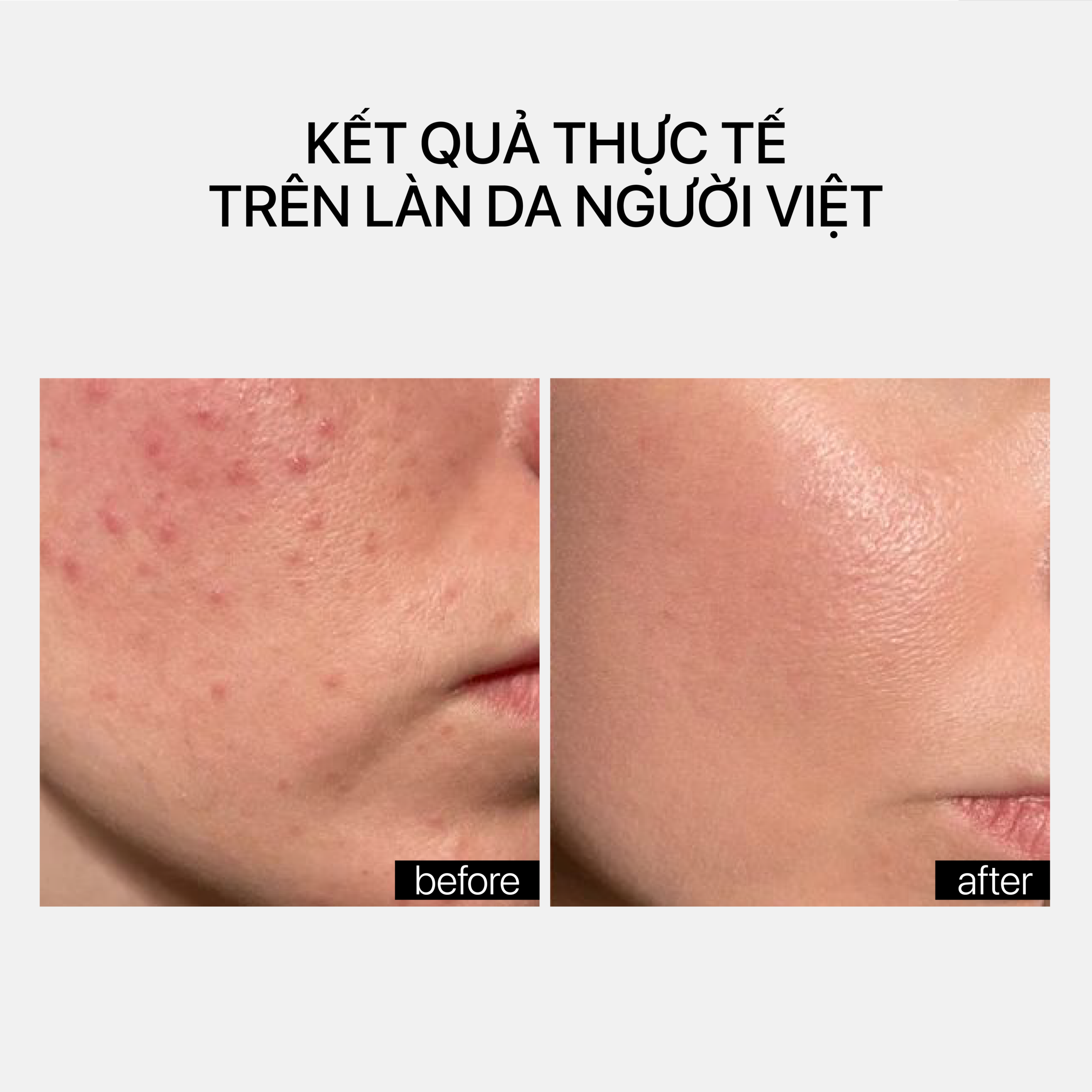 ADULT ACNE TREATMENT - Ảnh 6