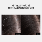 ANTI-DANDRUFF SCALP TREATMENT - Ảnh 2