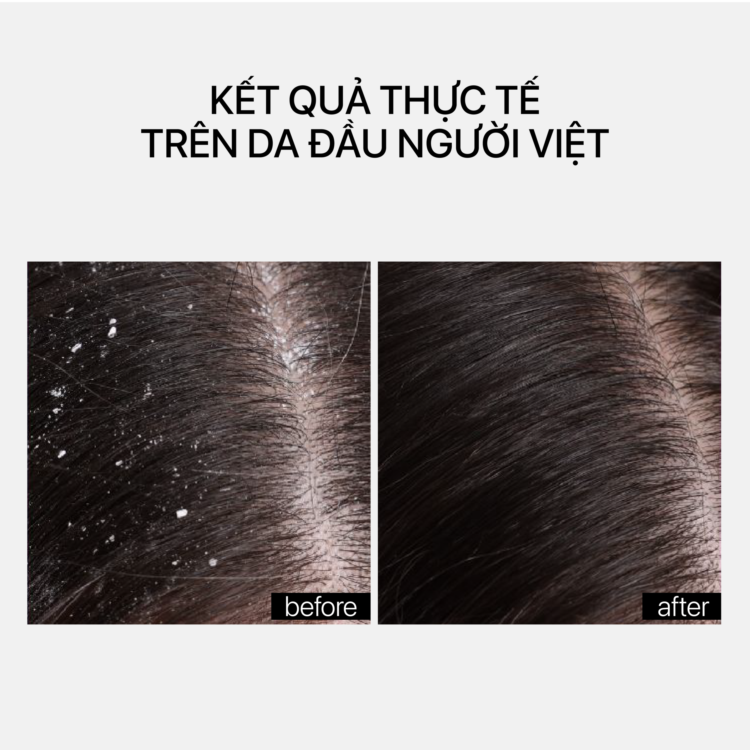 ANTI-DANDRUFF SCALP TREATMENT - Ảnh 2