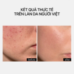 BLEMISH CONTROL BHA CLEANSER PH 3.5 - Ảnh 5