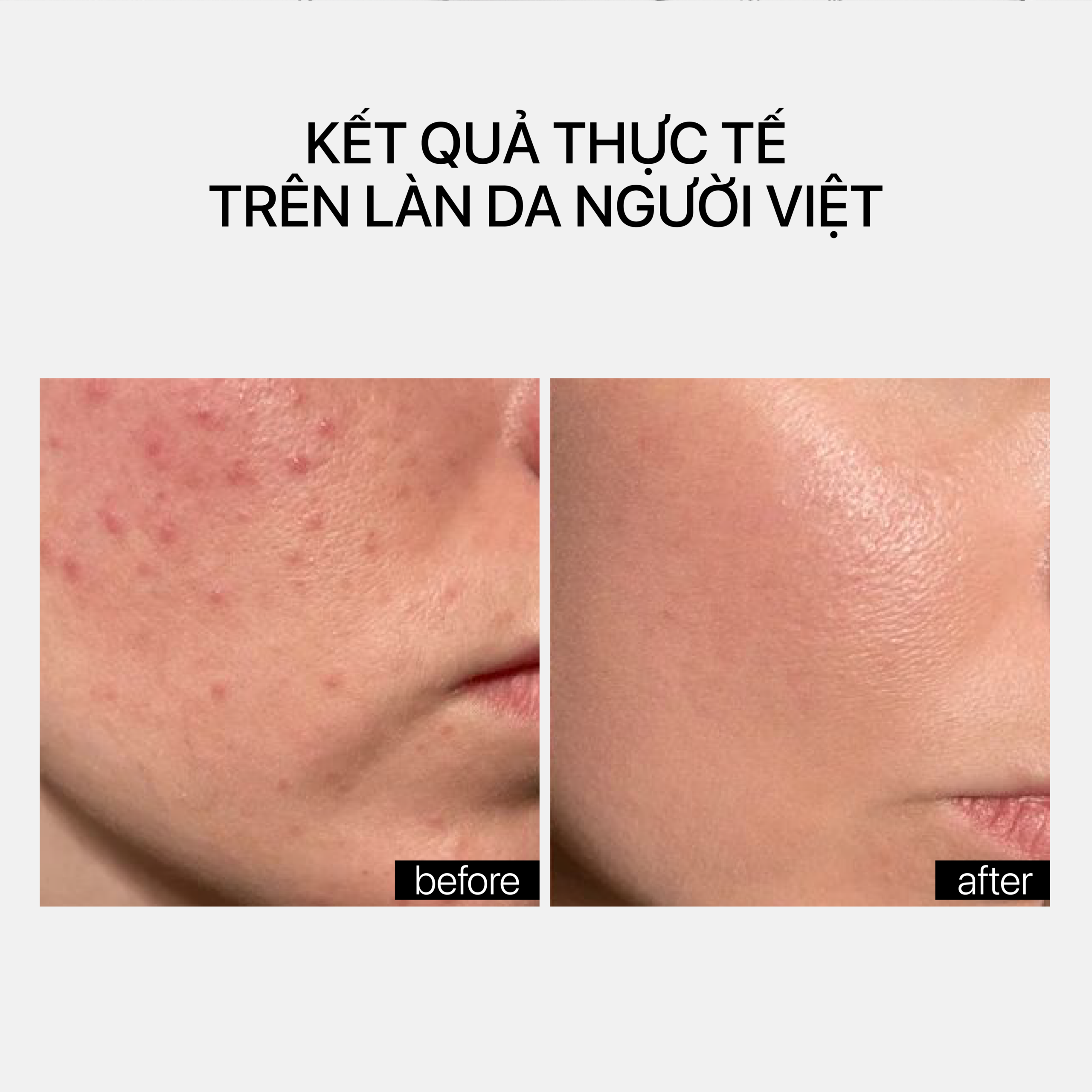 BLEMISH CONTROL BHA CLEANSER PH 3.5 - Ảnh 5