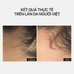 HAIR DENSITY SCALP TREATMENT - Ảnh 4