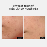 PIE ACNE RED SPOT FADING TREATMENT - Ảnh 3