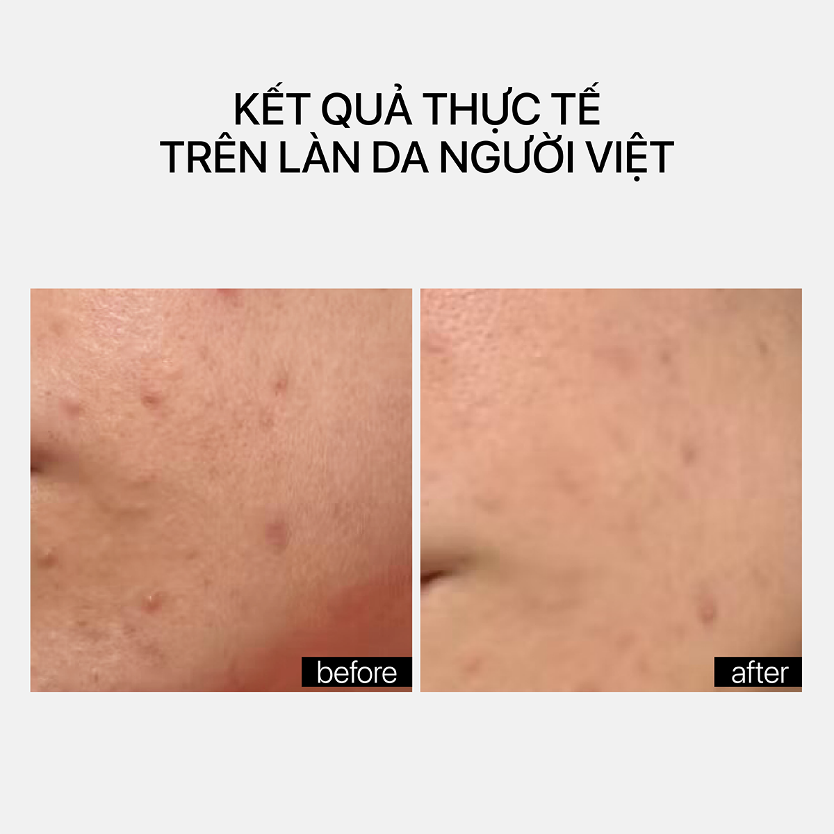 PIE ACNE RED SPOT FADING TREATMENT - Ảnh 3
