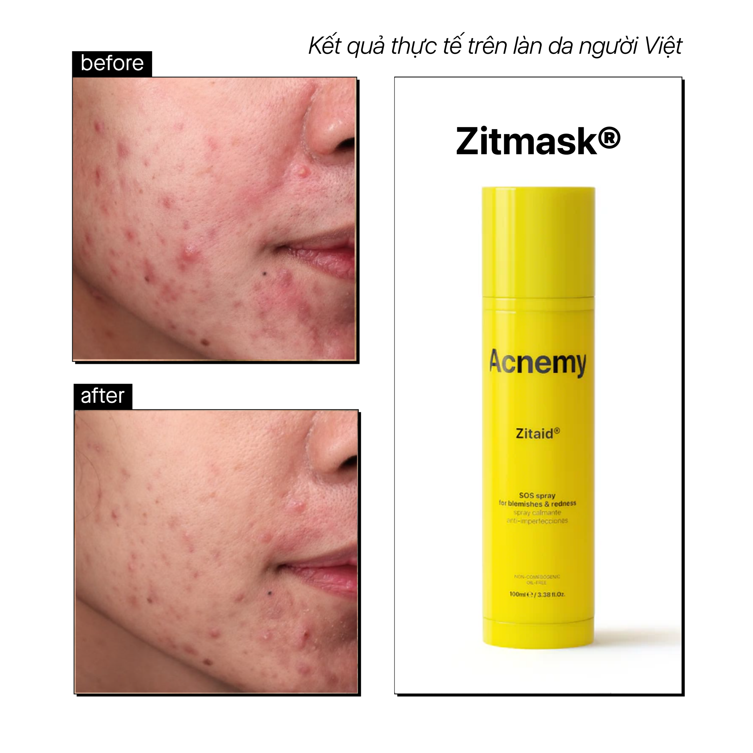 ACNEMY ZITAID® - Ảnh 4