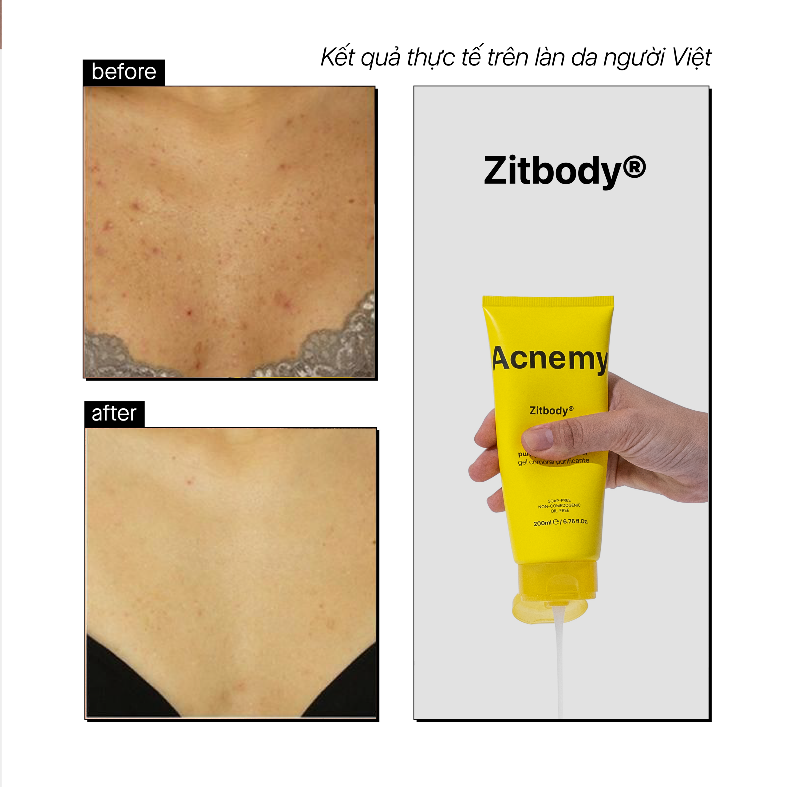 ZITBODY® POST BREAKOUT TREATMENT - Ảnh 5
