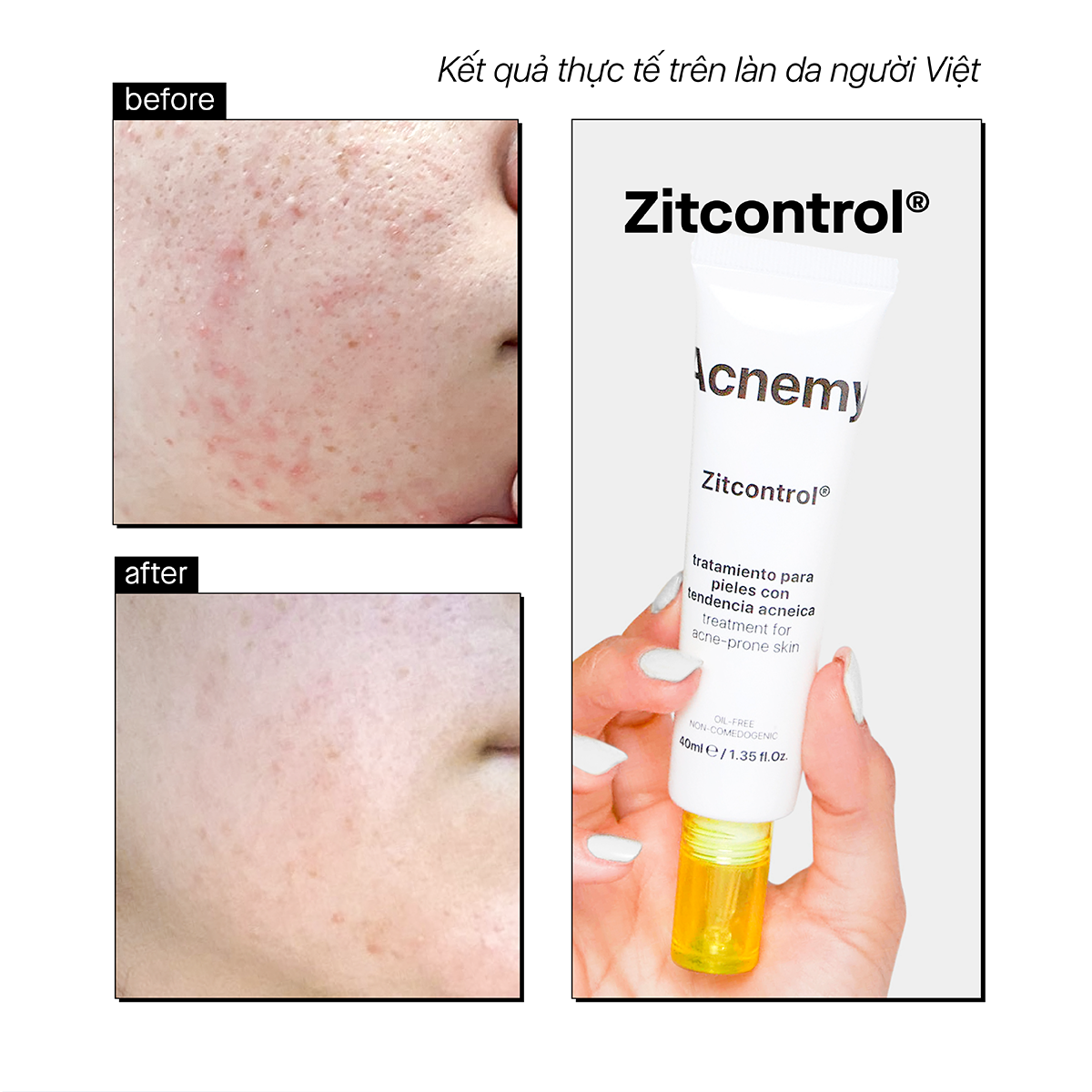 ZITCONTROL® BLEMISH CONTROL MOISTURIZER - Ảnh 4