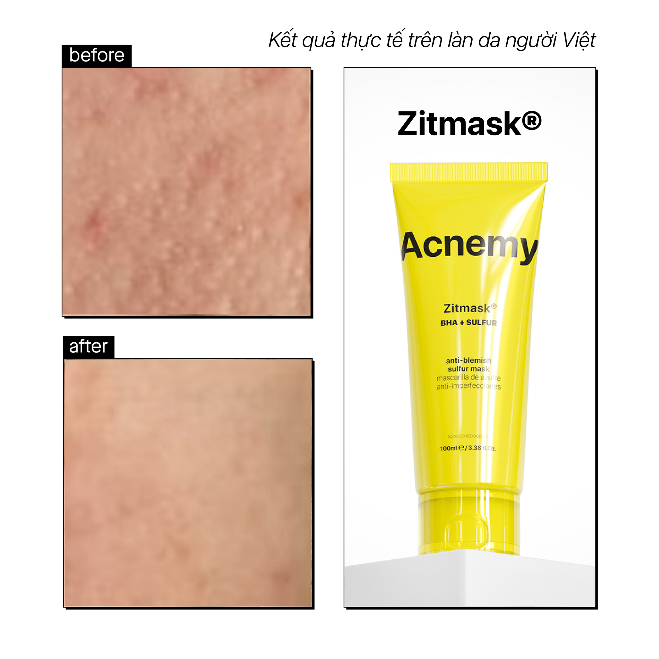 ZITMASK® ANTI-BLEMISH SULFUR MASK - Ảnh 4