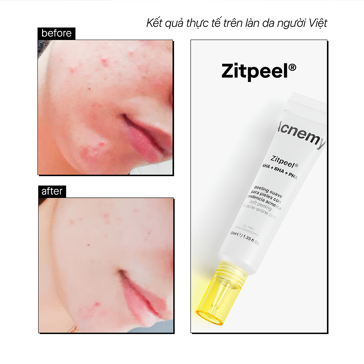 ZITPEEL® AHA+BHA+PHA - Ảnh 4