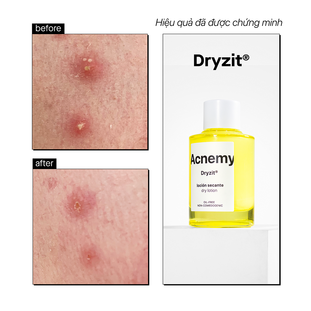 DRYZIT® SPOT DRYING LOTION - Ảnh 5
