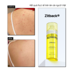 ZITBACK® POST BREAKOUT TREATMENT - Ảnh 5