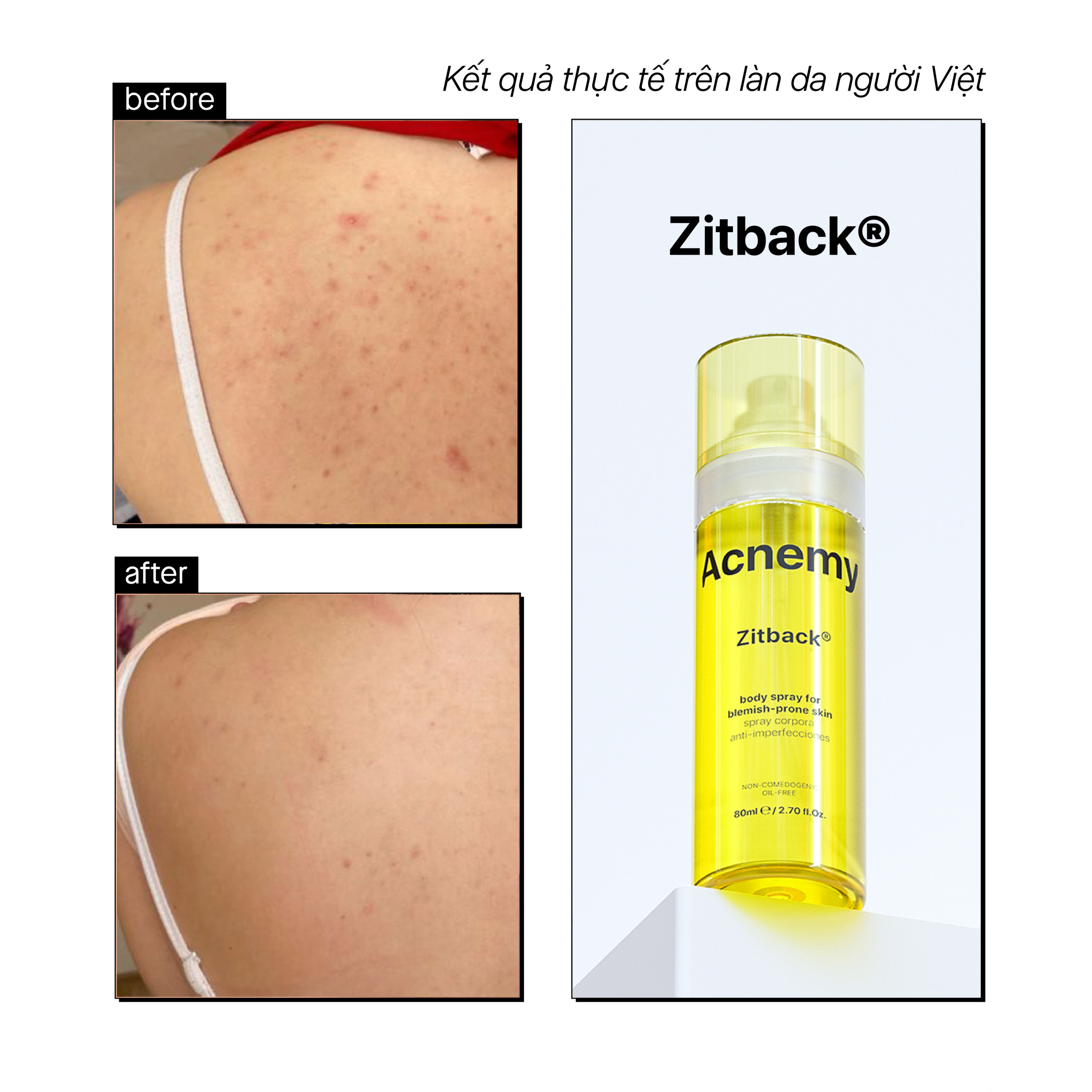 ZITBACK® POST BREAKOUT TREATMENT - Ảnh 5