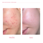 BLEMISH PREVENTING SERUM Tinh chất cho da dầu mụn - Ảnh 3